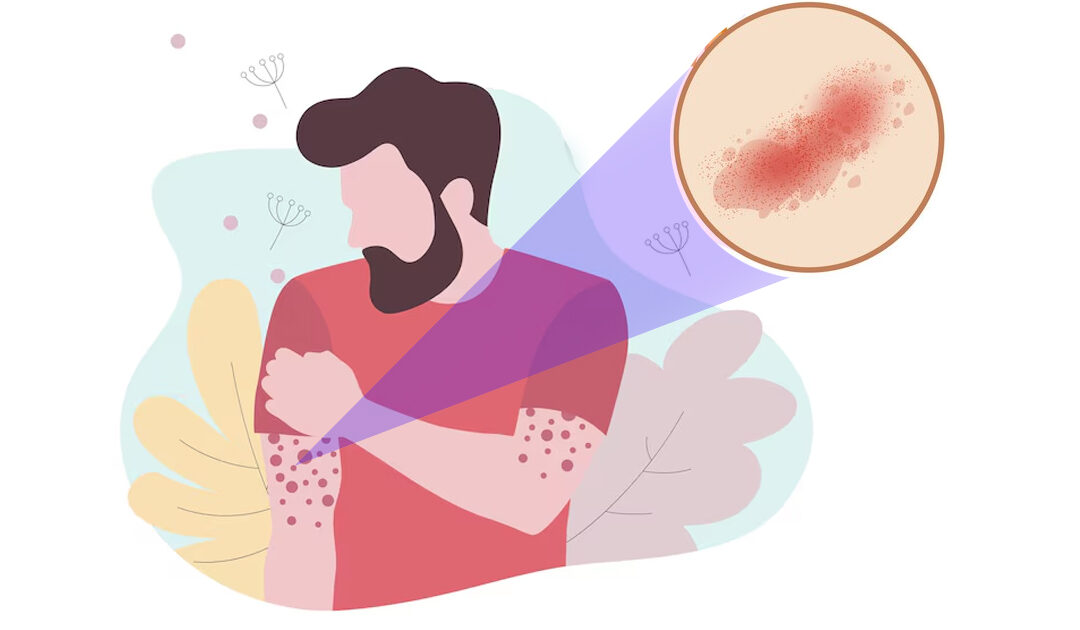 Μεταλοιμώδες Εξάνθημα: Τι είναι, πότε εμφανίζεται και γιατί μπορεί να ξεκινήσει ξαφνικά στην ενήλικη ζωή.